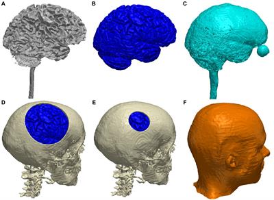 Optimized high-definition tDCS in patients with skull defects and skull plates